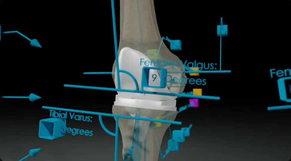 Knee Hip Animation